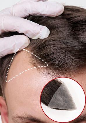 Patch Tempie | Patch Cutaneo per Capelli Uomo 3x2.5 Pollici (2 Pezzi)